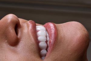لمینت کانتکت لنز (ونیر سرامیکی کم تراش) 8 Ceramic-veneer-in-Tehran.jpg