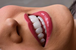 لمینت کانتکت لنز (ونیر سرامیکی کم تراش) 5 Ceramic-veneer-in-north-Tehran.jpg