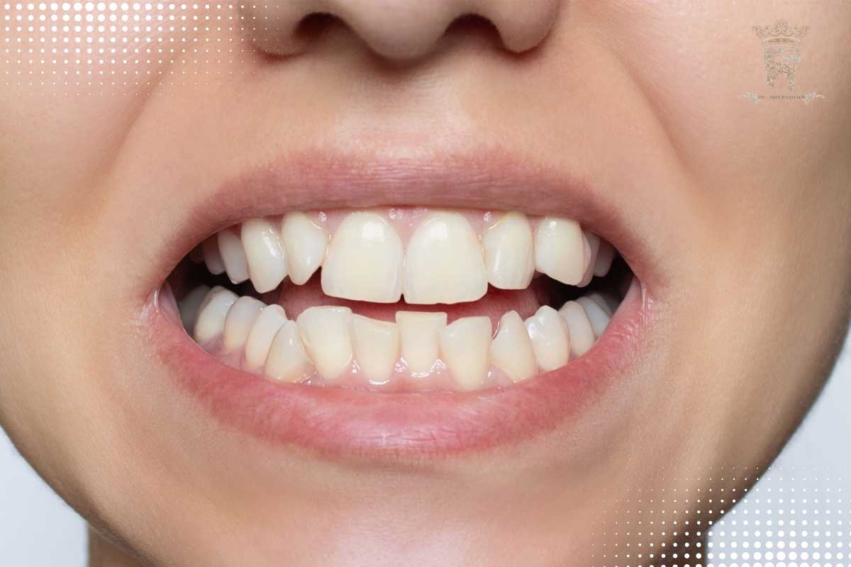اصلاح طرح لبخند بدون ارتودنسی 1 اصلاح دندانهای نامرتب بدون ارتودنسی