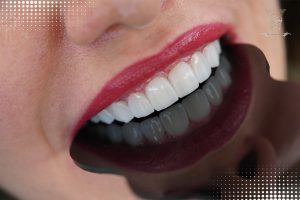 لمینت کانتکت لنز (ونیر سرامیکی کم تراش) 9 Ms.-Heydaris-work-Ceramic-veneers.jpg