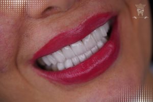 لمینت کانتکت لنز (ونیر سرامیکی کم تراش) 7 Smile-design-with-Lumineers-1.jpg