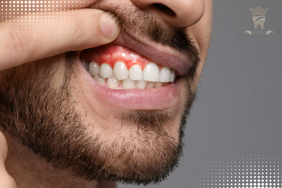 روشهای فوری و خانگی برای خارج کردن عفونت دندان :چگونه عفونت دندان را خارج کنیم؟ 8 درمان دندان عقل عفونی