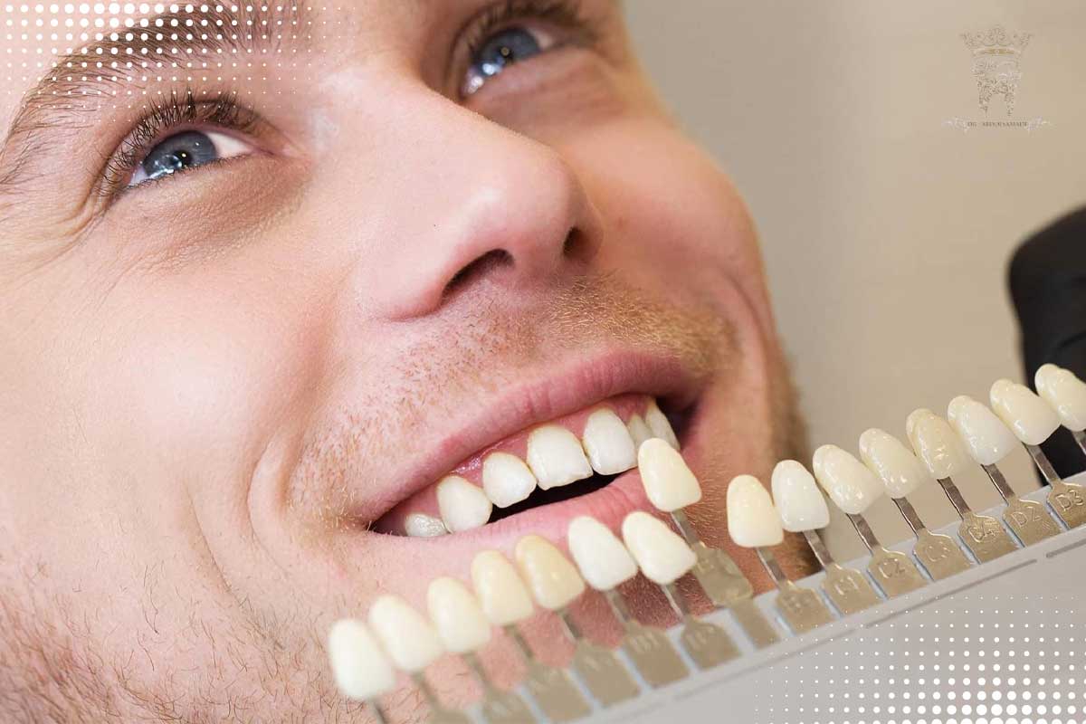 اصلاح طرح لبخند مردانه 4 انواع روشهای اصلاح طرح لبخند مردانه