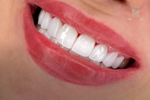 لمینت کانتکت لنز (ونیر سرامیکی کم تراش) 11 dental-veneer-after.png