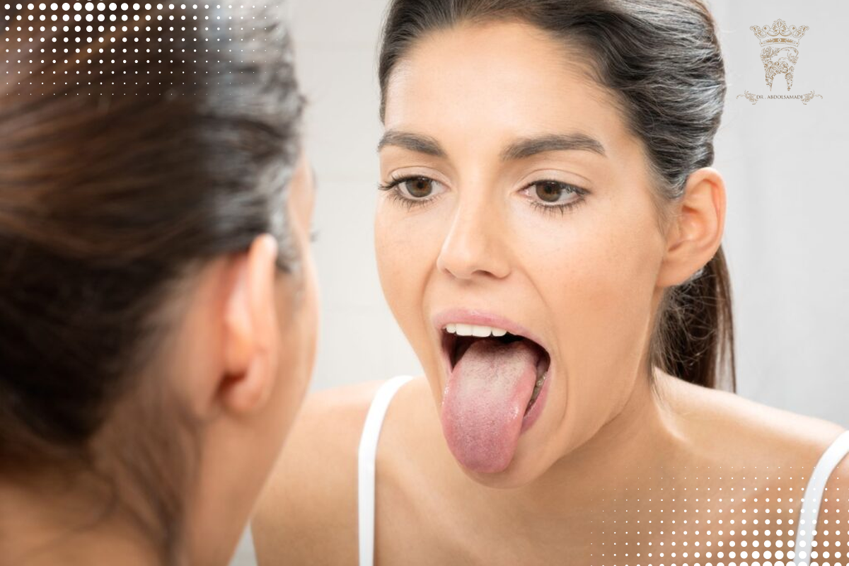 oral thrush