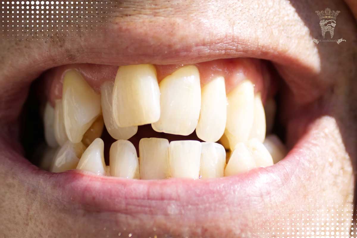آناتومی دندان؛ ساختار، انواع دندانها و تفاوت دندانهای شیری و دائمی 8 بیماریهای شایع در ساختار دندان
