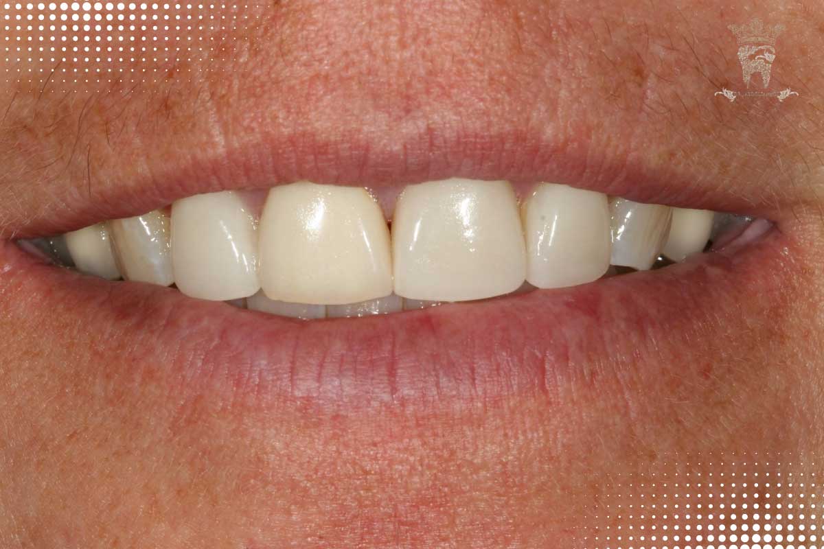 عوارض و معایب کامپوزیت دندان چیست؟ 3 عوارض کامپوزیت دندان های جلو