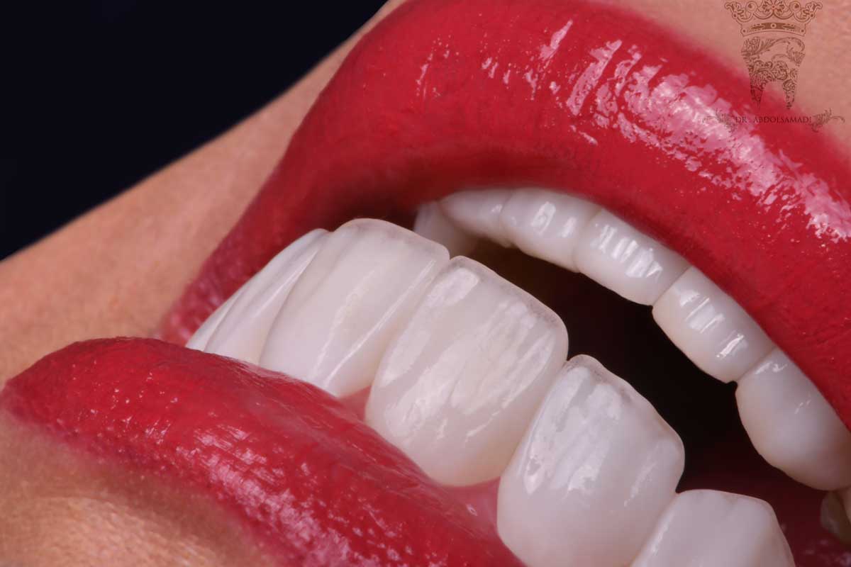دندانپزشکی زیبایی در قیطریه: تحولی در زیبایی و سلامت دهان و دندان 3 لمینت دندان در قیطریه