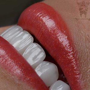 قیمت لمینت دندان 1404 (لمینت دندان در تهران) 2 Dental-laminate-treatment-example