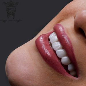 قیمت لمینت دندان 1404 (لمینت دندان در تهران) 3 Dental-laminate-treatment-example-with-Dr.-Abdolsamadi