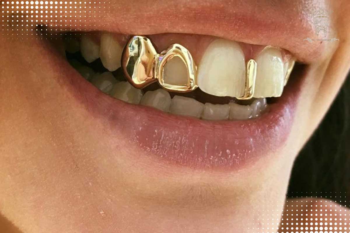 گریلز دندان؛ زینتی و لوکس یا تهدیدی برای سلامت دهان؟ 3 جنسهای مختلف گریلز دندان