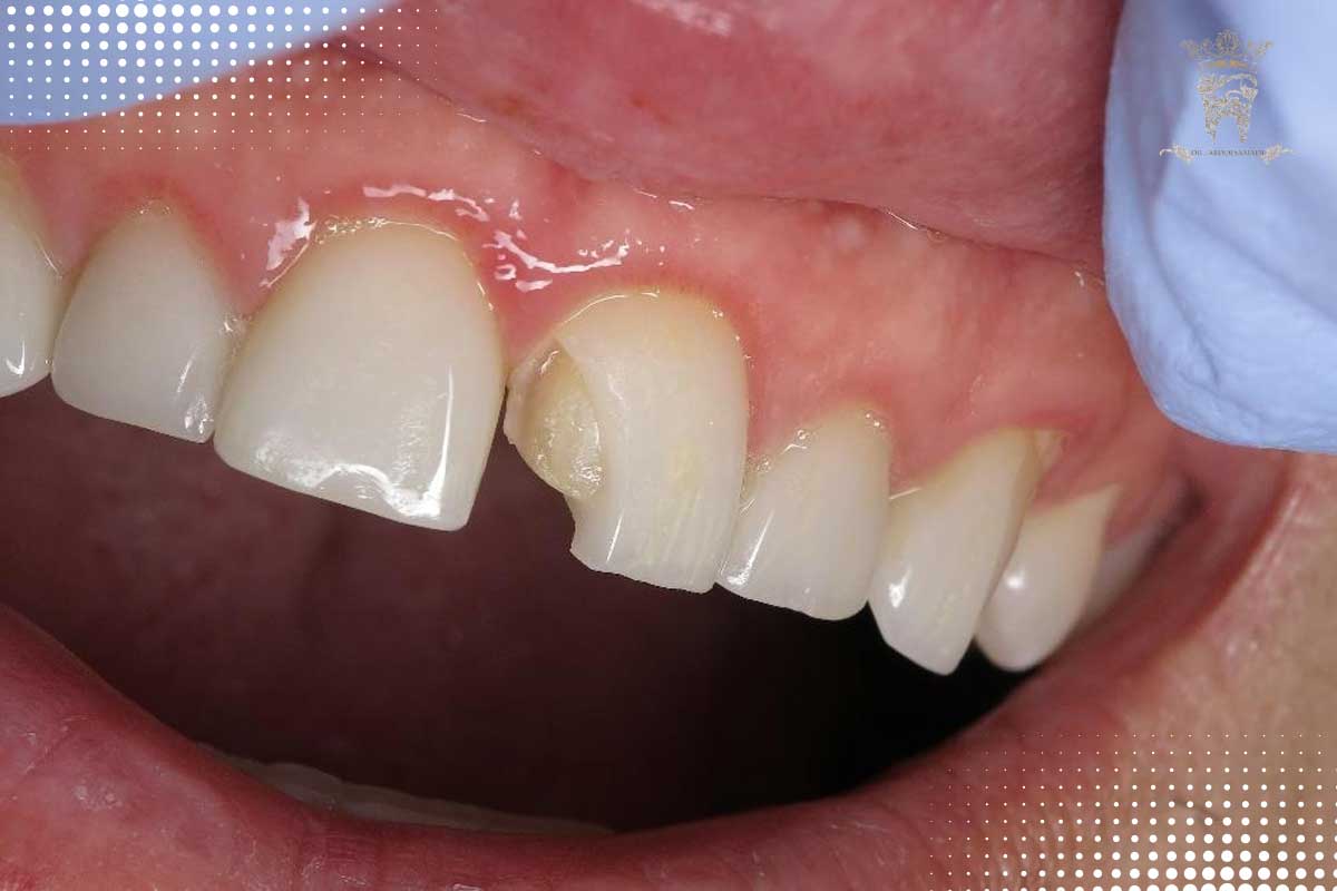 لمینت شیشه ای دندان؛ راهنمای کامل لمینت لبه شفاف 4 معایب و محدودیتها در لمینت لبه شیشهای
