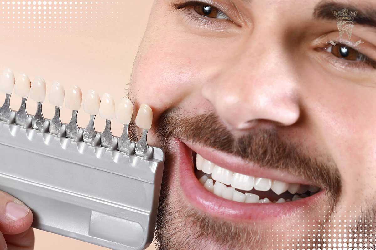 مزایا و معایب لمینت برلیانس برند جدید حوزه زیبایی 3 مراحل انجام لمینت برلیانس