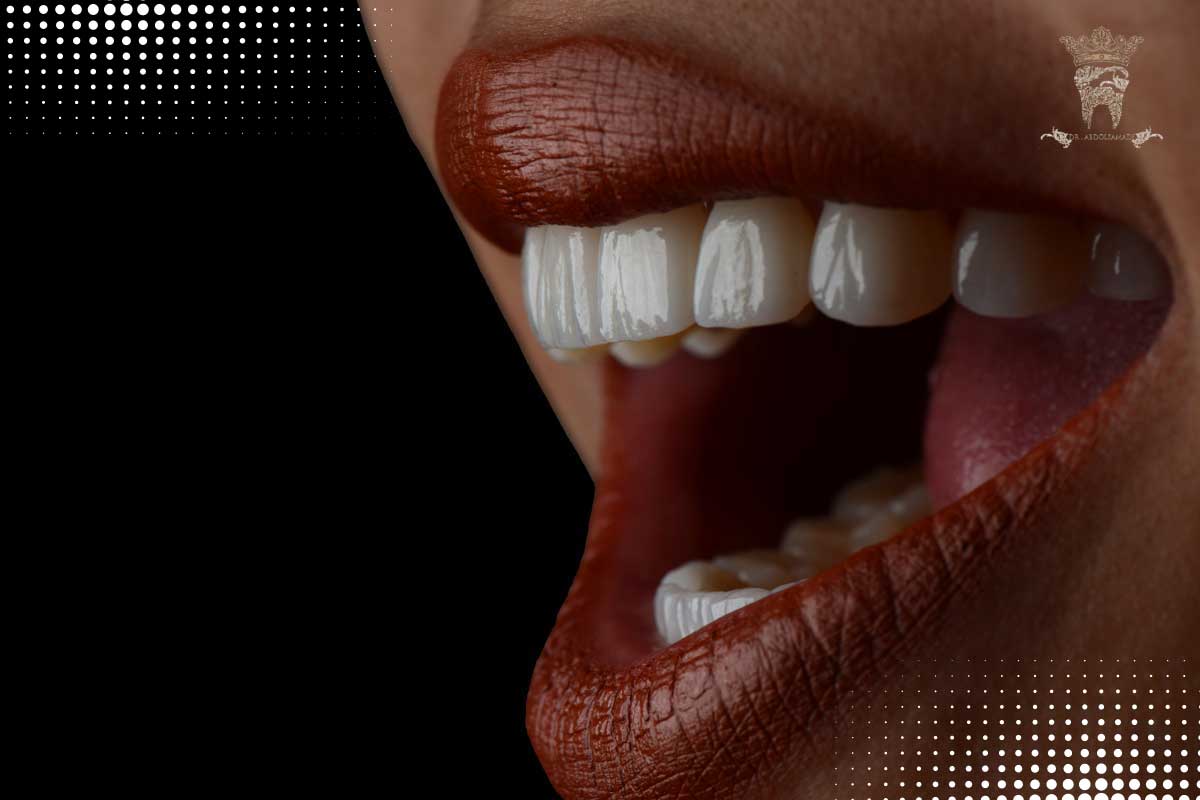 مزایا و معایب لمینت برلیانس برند جدید حوزه زیبایی 1 تفاوت لمینت برلیانس با سایر لمینتهای دندان