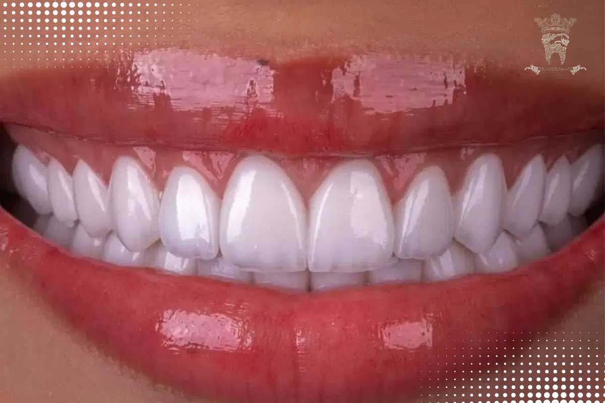 لمینت شیشه ای دندان؛ راهنمای کامل لمینت لبه شفاف 1 تفاوت ظاهری لمینت شیشهای با لمینتهای کلاسیک