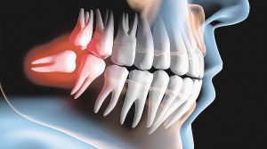 آناتومی دندان؛ ساختار، انواع دندانها و تفاوت دندانهای شیری و دائمی 6 wisdom teeth service 1