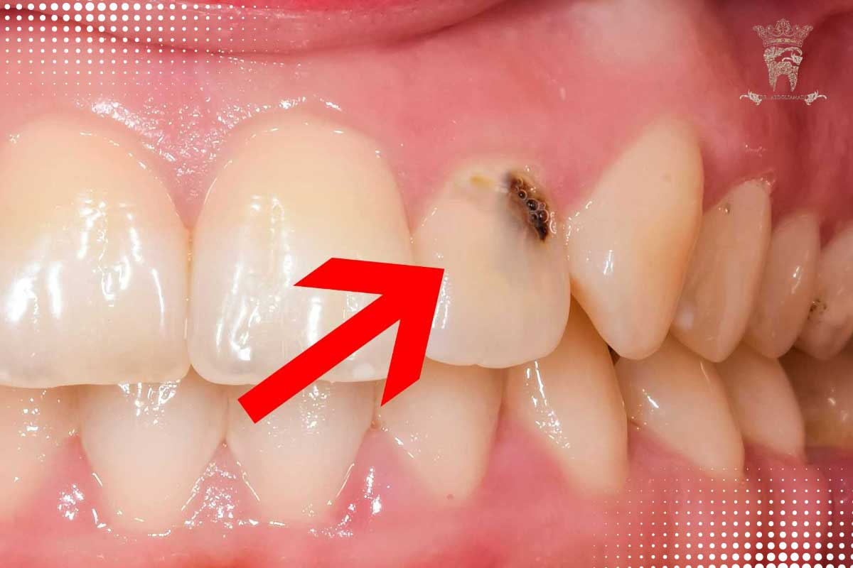 پرکردن دندان با مواد سفید خوبه یا سیاه؟ 5 پوسیدگی ریشه دندان