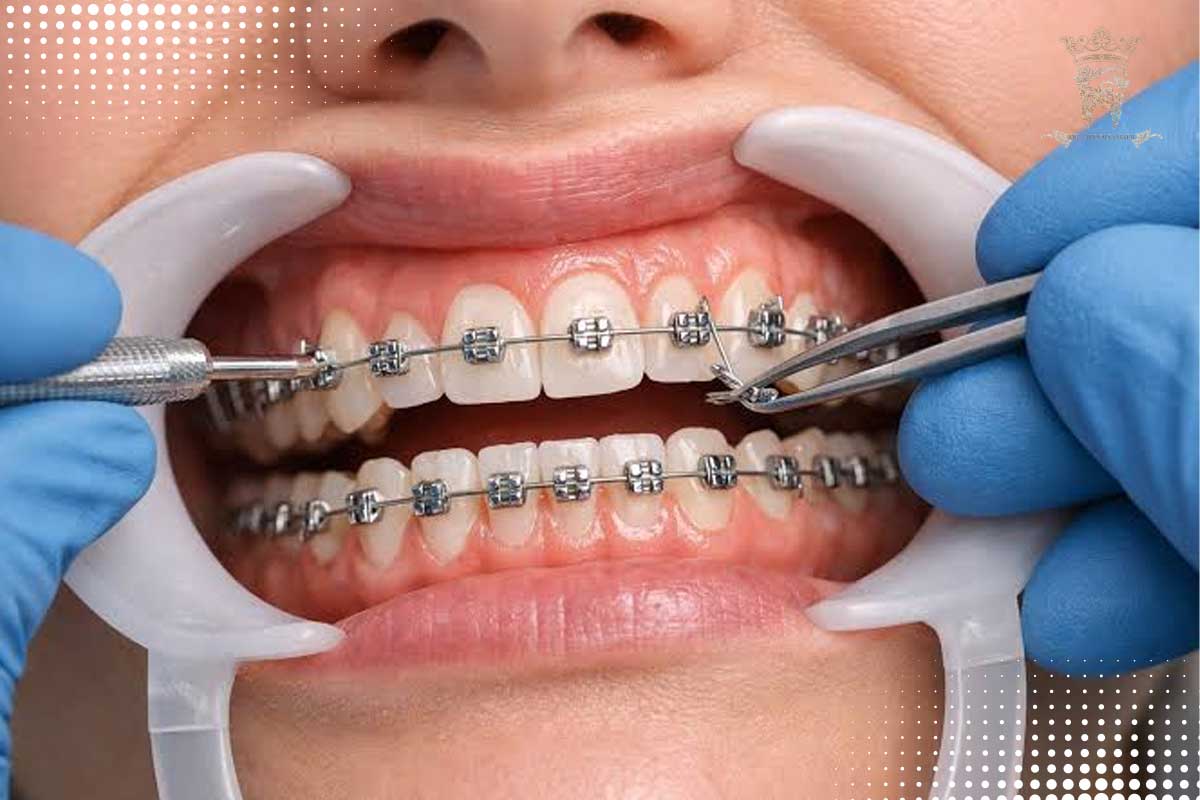 زبان زدن به دندان خراب (Tongue Thrust)؛ علائم، علل و بهترین روشهای درمان این عادت 3 بهترین روشهای درمان زبان زدن به دندان خراب