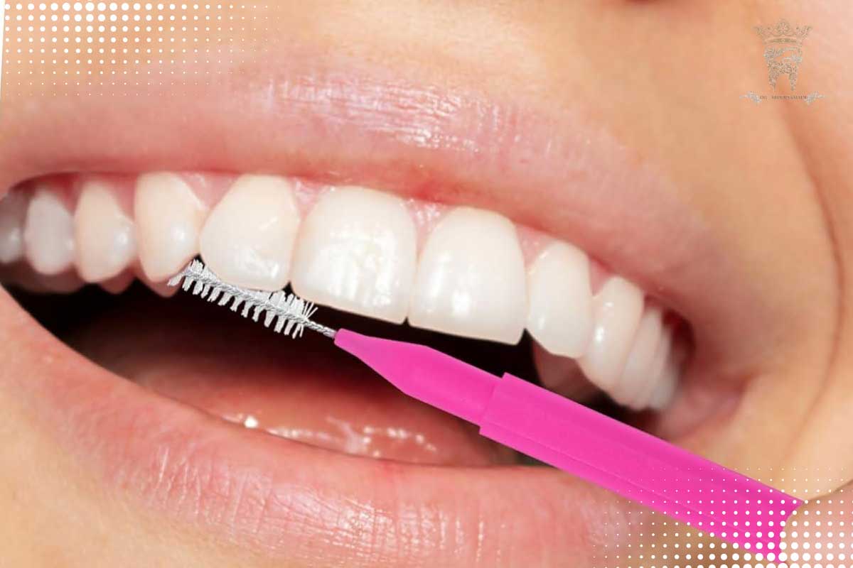 پوسیدگی دندان زیر لمینت :آیا زیر لمینت پوسیده میشود؟ 4 مراقبت از دندان لمینتشده