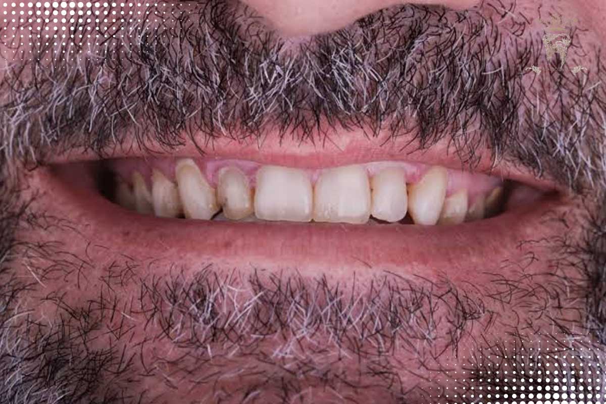 پوسیدگی دندان زیر لمینت :آیا زیر لمینت پوسیده میشود؟ 1 پوسیدگی لمینت دندان