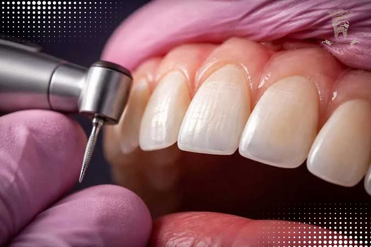 دلایل اصلی شکستن لمینت دندان که باید بدانید: از عادات غلط تا خطاهای نصب 1 Dental laminate fracture