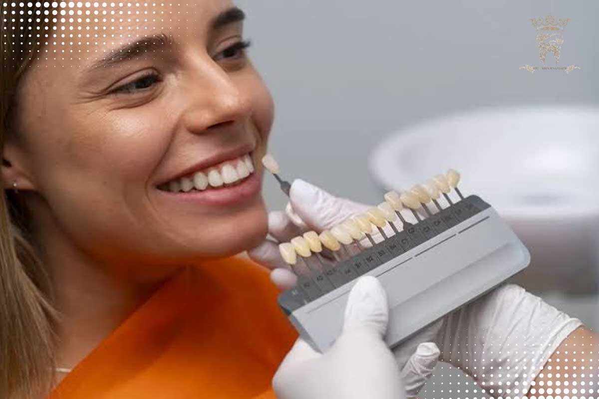 پوسیدگی دندان زیر لمینت :آیا زیر لمینت پوسیده میشود؟ 3 لمینت فوری