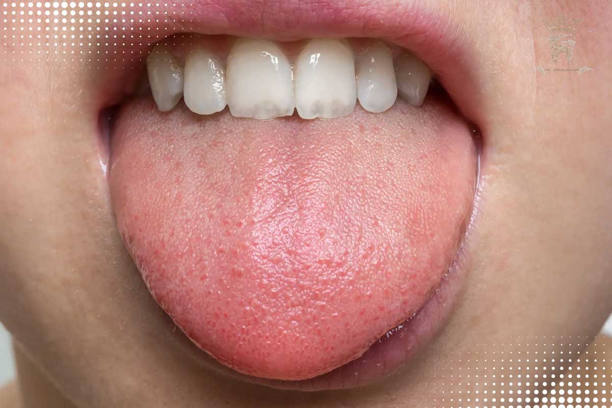 زبان زدن به دندان خراب (Tongue Thrust)؛ علائم، علل و بهترین روشهای درمان این عادت 2 نشانههای فشار زبان