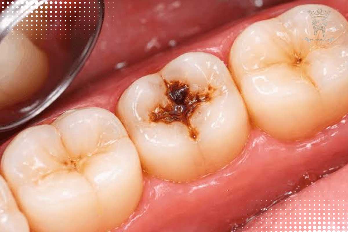 زبان زدن به دندان خراب (Tongue Thrust)؛ علائم، علل و بهترین روشهای درمان این عادت 4 خرابی دندان