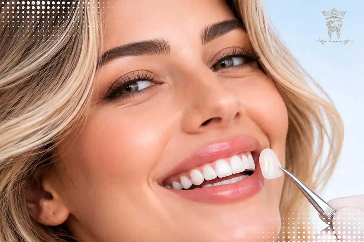 راههای تشخیص لومینیرز اصل از تقلبی؛ هر آنچه باید قبل از درمان بدانید 3 لومینیرز اصل