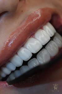 لومینیرز 1 لومینیرزدندان