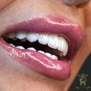 صفر تا صد طراحی لبخند دیجیتال (طرح لبخند) 17 نمونه طراحی لبخند دیجیتال دکتر عبدالصمدی